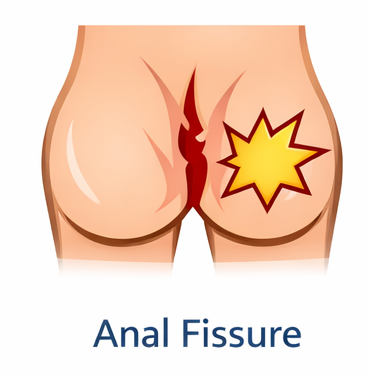 Anal Fisher